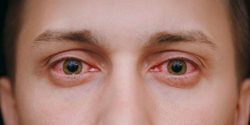 علت‌ قرمزی چشم
